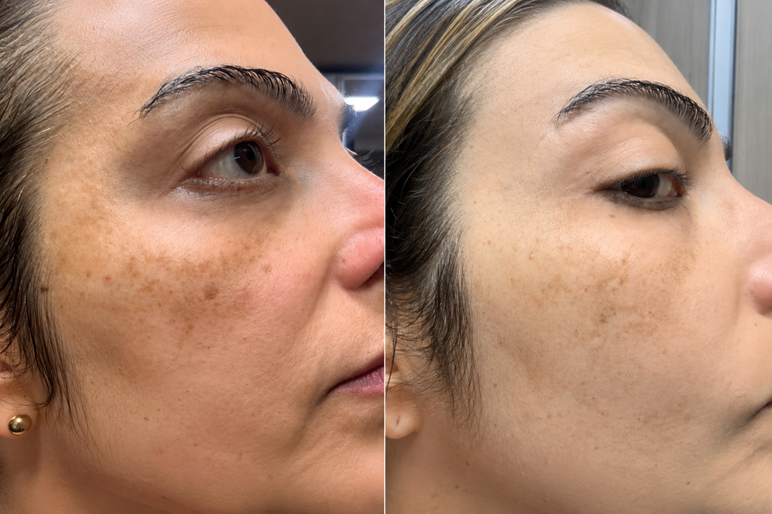 Dra. Fabiana Caetano, dermatologista, no proprio rosto: manchas na maca do rosto e depois de tres meses de uso da Bruma Clareadora MoonLit, com o tom mais uniforme