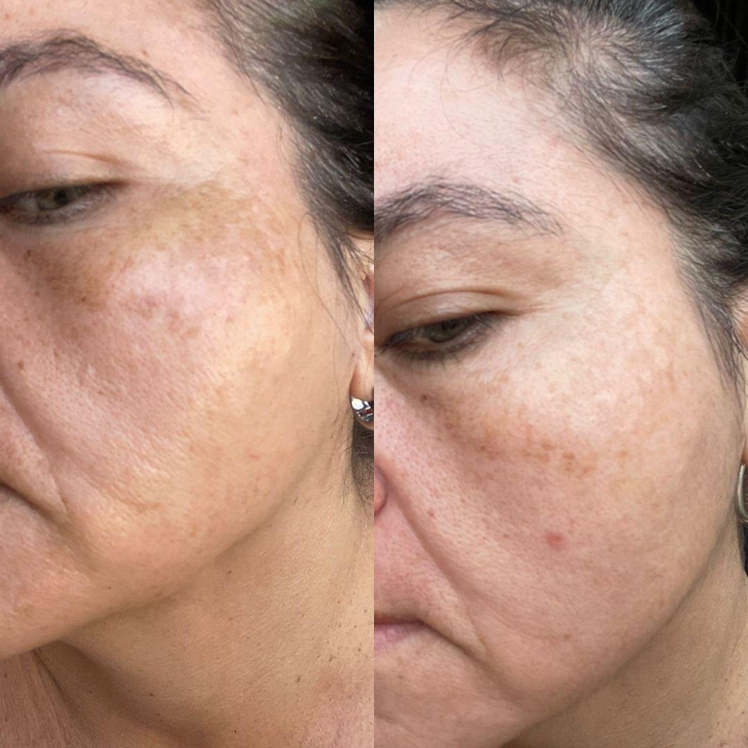 Antes e depois de 30 dias usando a Bruma MoonLit