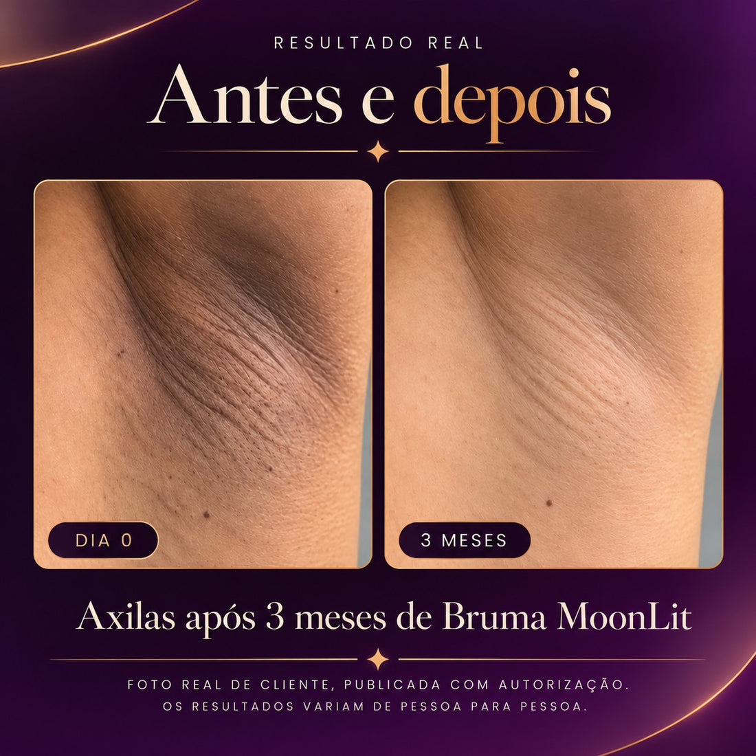 Antes e depois real nas axilas: pele escurecida no dia 0 e, depois de 3 meses de uso da Bruma MoonLit, tom mais claro e uniforme. Foto real de cliente, publicada com autorização; os resultados variam de pessoa para pessoa.