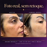 Antes e depois real com a Bruma MoonLit, 3 meses de uso 2 vezes ao dia. Foto real, sem retoque; os resultados individuais podem variar.