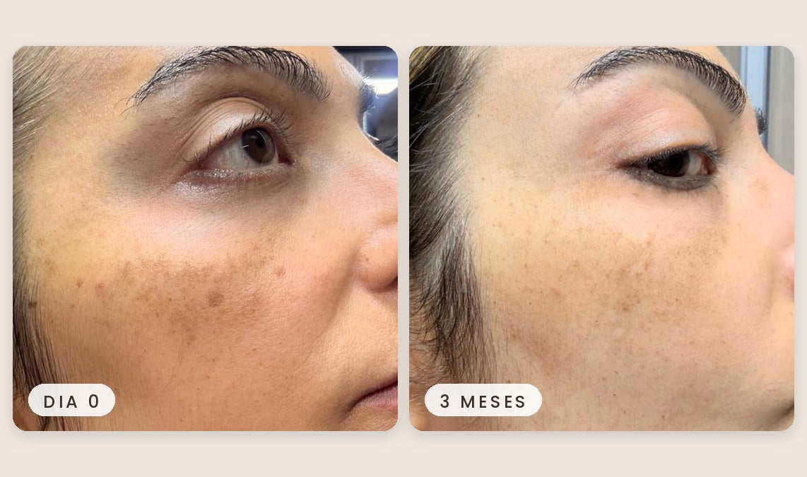 Antes e depois real de cliente usando a Bruma Clareadora MoonLit